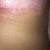 Suture holding up my healing process. My boss (ob/gyn) clipped it for me and it healed within days