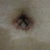 3 weeks post-op. bb up close, those inner bumps are firm, probably with swelling. as you can see, everything looks dark from the scarring, but I'm hoping it gets better.