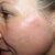 Day #7 Left side - as you can see, I still have some scar pigmentation as well as a raw spot near my temple.