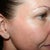 Day #7 Right side - on this side is very good improvement.  Skin is smoother, color is more even.