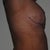 6 weeks post-op