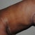 6 weeks post-op