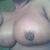 Post op Day 6 Swollen C  cup 12/11/12