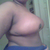 Post op Day 6 12/11/12