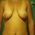 Pre op-Front view