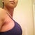 Side view.  I love my higher projection implants