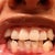 Without trays. You can see a few attachments a little bit. They are so small. They look bigger on the aligners to fit them.
