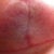 Week 7 Right t zone.  Scabs are all gone!