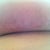 view from underneath.... scar is nice and small