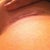 Apparently I forgot to post this from around my 2 or 3 month mark- here's how the scar looked then. That's something I was really concerned about before surgery. No one wants scars!!!