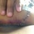 Bruising