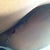 Bruising