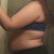 Night before lipo