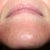 Day #4 chin area - this is the worst-looking area at this point.  I guess because the skin is thinner here.  Not sure if you can see in the picture the tiny pimples that have cropped up.  Some of them have already resolved themselves, but a few remain.