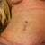 This was at my 3 week pot op appointment. These are the only appointments when I have all tape off so I snapped a quick photo. Everything healing great!