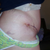 2wks 2 days post op. Im still really swollen and
bruised. But, so satisfied with the results so far. = )