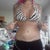 19 days PO .... starting to look better, but still swollen as hell!!!!