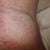 Day 2 - pretty swollen, mostly gone now on day 7.