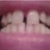 Beginning of Tray 2- without Invisalign