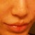 2 wks after Juvederm Ultra Plus, volume is dramatically lower