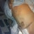 Day 1 Post op, still at the surgery center