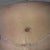 2 days post op