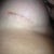 Right incision 1 week post op