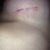 Left incision 1 week post op