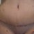 front view 5 weeks post op