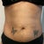 Before - Stretch marks with saggy skin