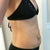 Before - belly bulge