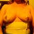 17 days post op