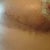 2wks PO side - steri strip irritation