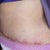 Post Op Day 9.