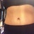Front view 4 months Post op.