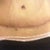 Scar 4 months post op. hides well underneath 
 panties and pants. The red mark below the scar is a tear. It going away and didn't bother me.