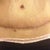 Scar after 4 months post op