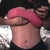 7 days post op