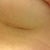 3 weeks left scar
