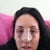 Day two after surgery