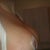 2 weeks Post Op side