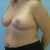 8 weeks post op3