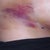 bruising