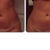 Morning before procedure/after procedure- day 1... swollen, but can already see the lumps beginning to smooth out