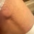 This is the inside of my left thigh. The bump appears to be close to where the incision for the lipo cannula was made. This is 4 wks out from surgery