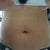 Same day after procedure.  My stomach is swollen, but you get the general idea.