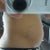 Same day after procedure.  My stomach is swollen, but you get the general idea.