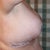 Post op day 1 right side