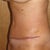 Left view - 10 days