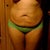 Before Tummy Tuck